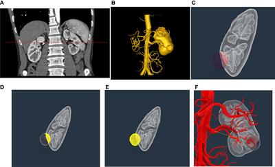 Identification of predictive factors for outcomes after robot-assisted partial nephrectomy based on three-dimensional reconstruction of preoperative enhanced computerized tomography